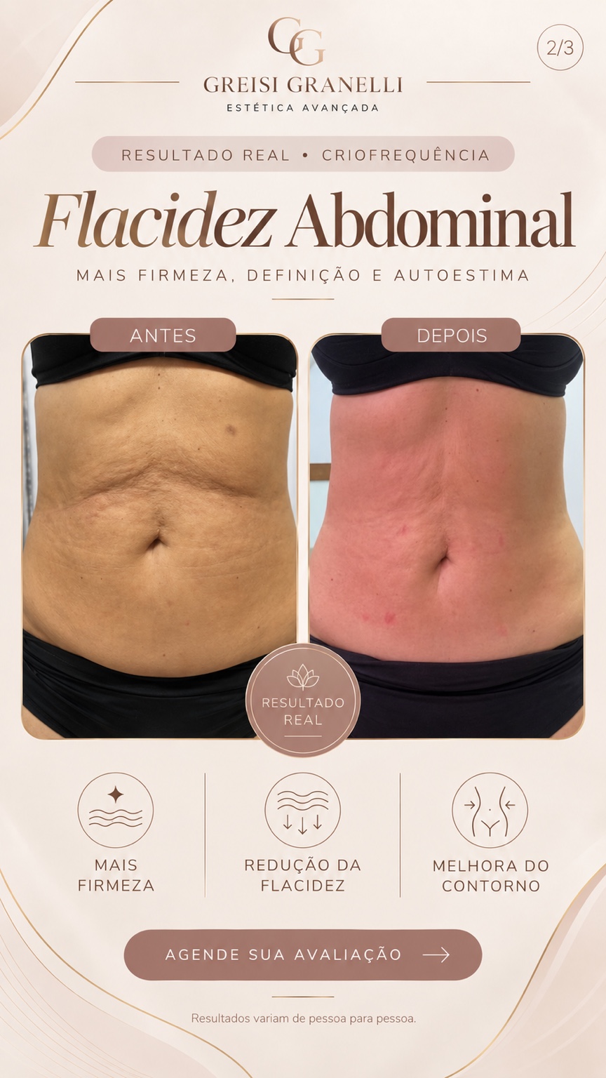 Antes à esquerda e depois à direita: flacidez abdominal, com criofrequência e procedimentos individualizados